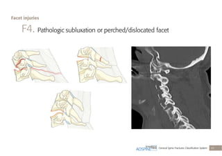 Cervical Spine Fractures Classiﬁcation System 29
F4. Pathologic subluxation or perched/dislocated facet
Facet injuries
 
