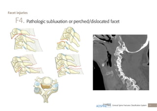 Cervical Spine Fractures Classiﬁcation System 31
F4. Pathologic subluxation or perched/dislocated facet
Facet injuries
 