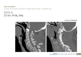 Cervical Spine Fractures Classiﬁcation System 33
C7-T1: C
(T1:A1; F4 BL; N4)
(assume bilateral)
Case Example 1.
25 year old male involved in high speed MVA, complete SCI
 