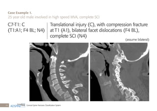 Cervical Spine Fractures Classiﬁcation System34
C7-T1: C
(T1:A1; F4 BL; N4)
Translational injury (C), with compression fracture
at T1 (A1), bilateral facet dislocations (F4 BL),
complete SCI (N4)
(assume bilateral)
Case Example 1.
25 year old male involved in high speed MVA, complete SCI
 