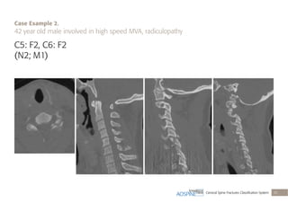 Cervical Spine Fractures Classiﬁcation System 35
C5: F2, C6: F2
(N2; M1)
Case Example 2.
42 year old male involved in high speed MVA, radiculopathy
 