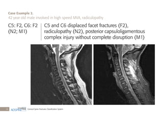 Cervical Spine Fractures Classiﬁcation System36
C5: F2, C6: F2
(N2; M1)
C5 and C6 displaced facet fractures (F2),
radiculopathy (N2), posterior capsuloligamentous
complex injury without complete disruption (M1)
Case Example 2.
42 year old male involved in high speed MVA, radiculopathy
 