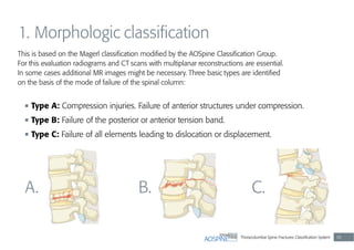 Thoracolumbar Spine Fractures Classiﬁcation System 39
1. Morphologic classiﬁcation
A. B. C.
This is based on the Magerl classiﬁcation modiﬁed by the AOSpine Classiﬁcation Group.
For this evaluation radiograms and CT scans with multiplanar reconstructions are essential.
In some cases additional MR images might be necessary. Three basic types are identiﬁed
on the basis of the mode of failure of the spinal column:
Type A: Compression injuries. Failure of anterior structures under compression.
Type B: Failure of the posterior or anterior tension band.
Type C: Failure of all elements leading to dislocation or displacement.
 