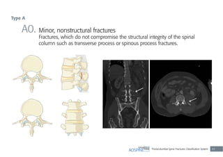 Thoracolumbar Spine Fractures Classiﬁcation System 43
A0. Minor, nonstructural fractures
Fractures, which do not compromise the structural integrity of the spinal
column such as transverse process or spinous process fractures.
Type A
 