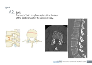 Thoracolumbar Spine Fractures Classiﬁcation System 45
A2. Split
Fracture of both endplates without involvement
of the posterior wall of the vertebral body.
Type A
 