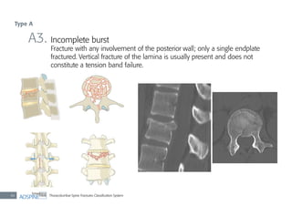 Thoracolumbar Spine Fractures Classiﬁcation System46
A3. Incomplete burst
Fracture with any involvement of the posterior wall; only a single endplate
fractured. Vertical fracture of the lamina is usually present and does not
constitute a tension band failure.
Type A
 