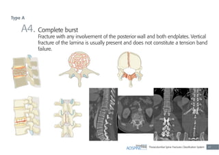 Thoracolumbar Spine Fractures Classiﬁcation System 47
A4. Complete burst
Fracture with any involvement of the posterior wall and both endplates. Vertical
fracture of the lamina is usually present and does not constitute a tension band
failure.
Type A
 