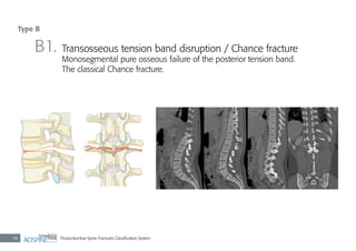 Thoracolumbar Spine Fractures Classiﬁcation System48
B1. Transosseous tension band disruption / Chance fracture
Monosegmental pure osseous failure of the posterior tension band.
The classical Chance fracture.
Type B
 