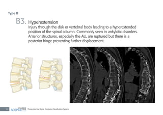 Thoracolumbar Spine Fractures Classiﬁcation System50
B3. Hyperextension
Injury through the disk or vertebral body leading to a hyperextended
position of the spinal column. Commonly seen in ankylotic disorders.
Anterior structures, especially the ALL are ruptured but there is a
posterior hinge preventing further displacement.
Type B
 