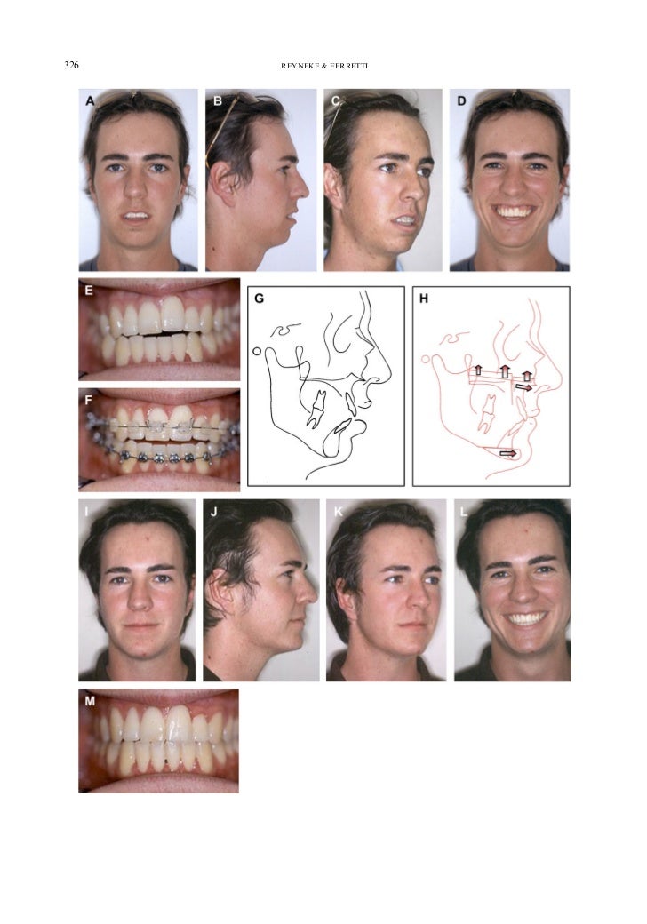 Aob correct by le fort i or bsso