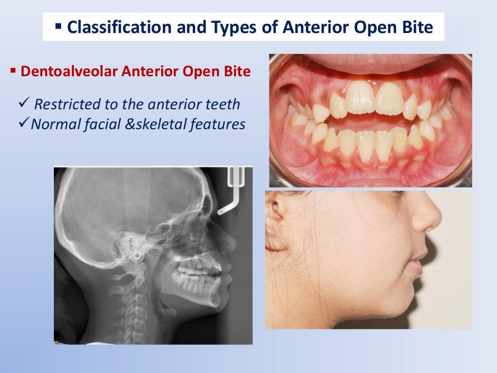 Anterior Open Bite etiology and differential diagnosis