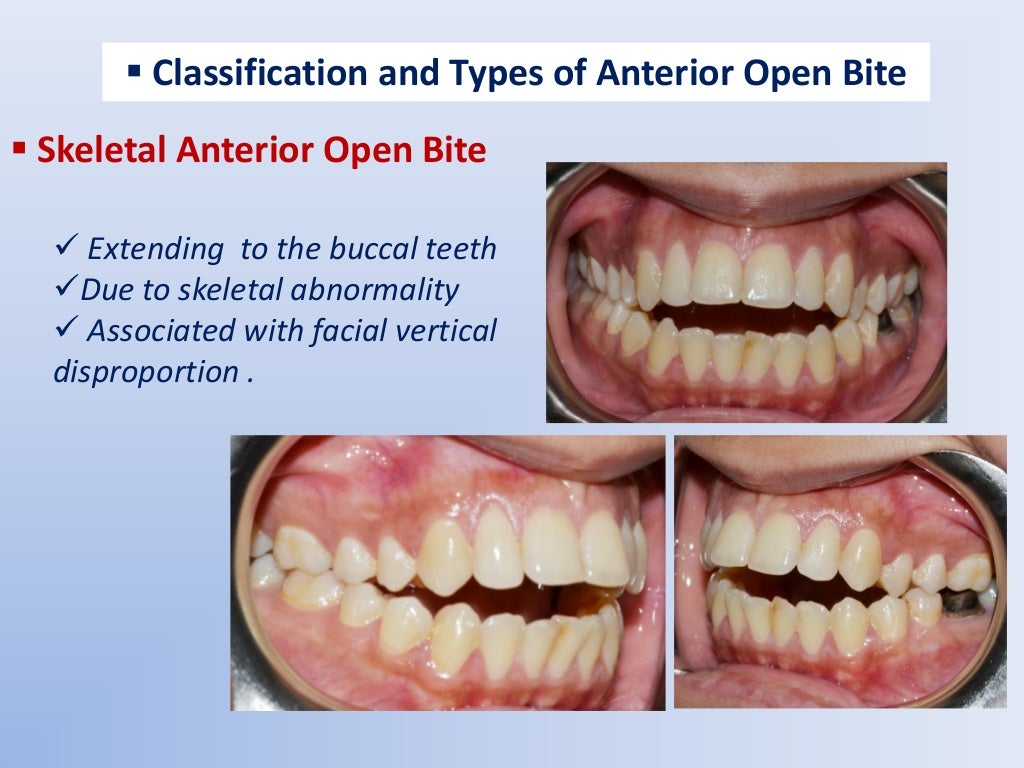 Anterior Open Bite etiology and differential diagnosis