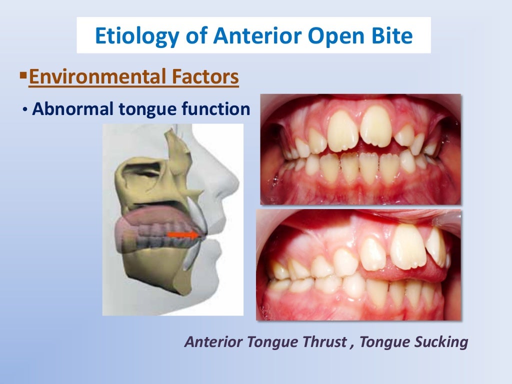 Anterior Open Bite etiology and differential diagnosis