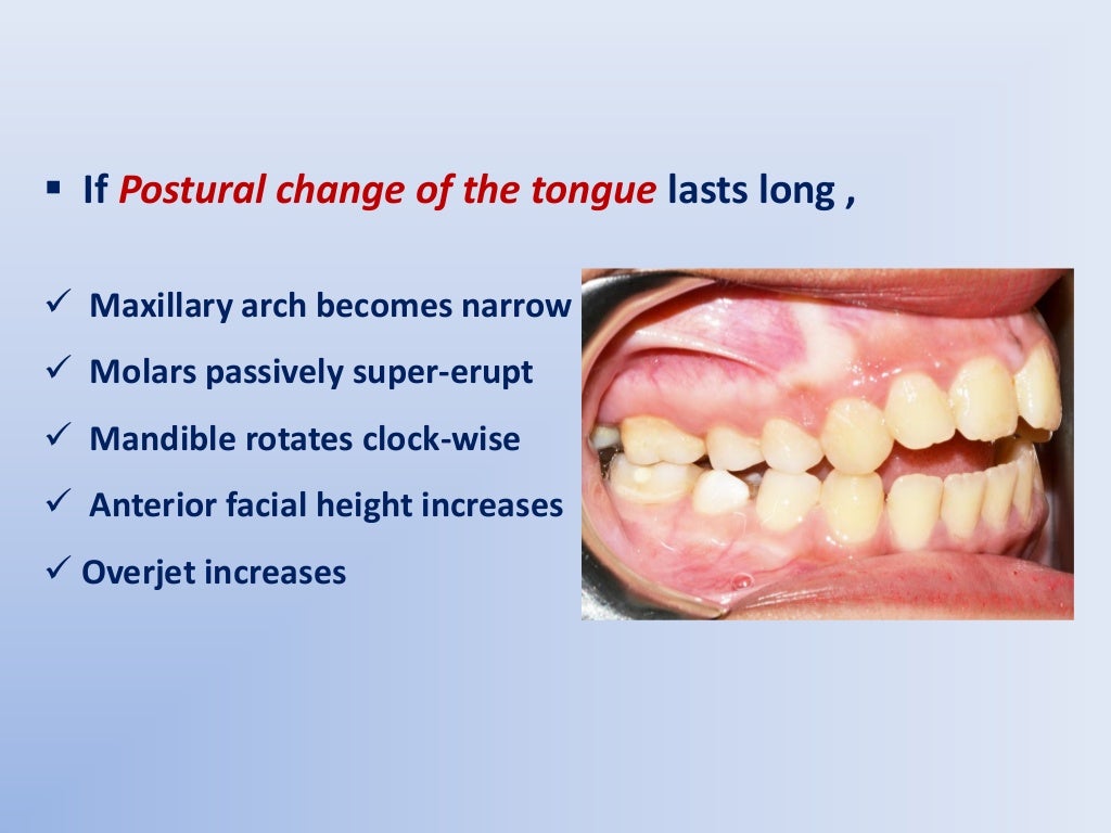 Anterior Open Bite etiology and differential diagnosis