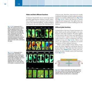 AO Book, Tech of reduction surrgical procedure | PDF