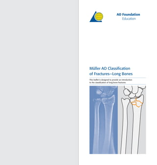 Müller AO Classiﬁcation
of Fractures—Long Bones
This leaﬂet is designed to provide an introduction
to the classiﬁcation of long-bone fractures.
 