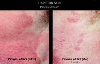 HAMPTON SKIN
Psoriasis Cream




                  2 weeks
 