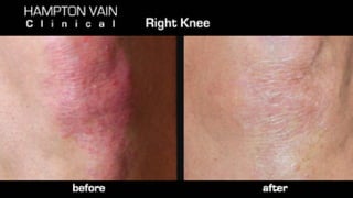 Psoriasis of right knee