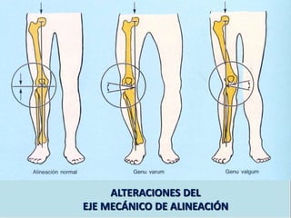ALTERACIONES DEL
EJE MECÁNICO DE ALINEACIÓN
 