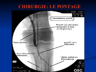CHIRURGIE: LE PONTAGE 