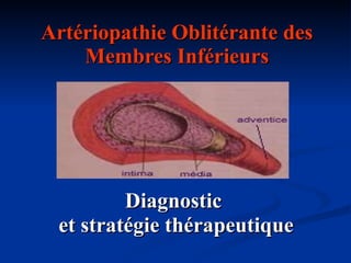 Artériopathie Oblitérante des Membres Inférieurs Diagnostic  et stratégie thérapeutique 