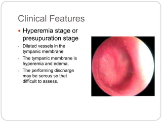 Clinical Features
 Hyperemia stage or
presupuration stage
- Dilated vessels in the
tympanic membrane
- The tympanic membrane is
hyperemia and edema.
- The performing discharge
may be serous so that
difficult to assess.
 