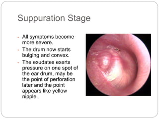 Suppuration Stage
- All symptoms become
more severe.
- The drum now starts
bulging and convex.
- The exudates exerts
pressure on one spot of
the ear drum, may be
the point of perforation
later and the point
appears like yellow
nipple.
 