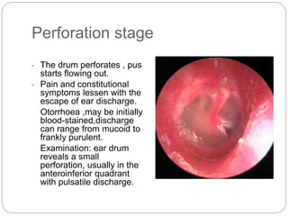 Perforation stage
- The drum perforates , pus
starts flowing out.
- Pain and constitutional
symptoms lessen with the
escape of ear discharge.
Otorrhoea ,may be initially
blood-stained,discharge
can range from mucoid to
frankly purulent.
Examination: ear drum
reveals a small
perforation, usually in the
anteroinferior quadrant
with pulsatile discharge.
 