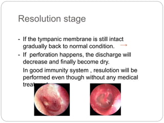 Resolution stage
- If the tympanic membrane is still intact
gradually back to normal condition.
- If perforation happens, the discharge will
decrease and finally become dry.
In good immunity system , resulotion will be
performed even though without any medical
treatment
 