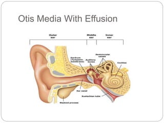 Otis Media With Effusion
 