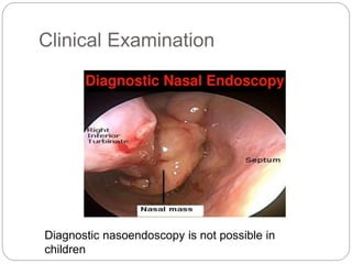 Clinical Examination
Diagnostic nasoendoscopy is not possible in
children
 