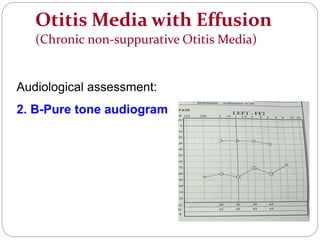 Otitis Media with Effusion
(Chronic non-suppurative Otitis Media)
Audiological assessment:
2. B-Pure tone audiogram
 
