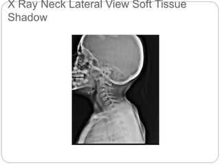 X Ray Neck Lateral View Soft Tissue
Shadow
 