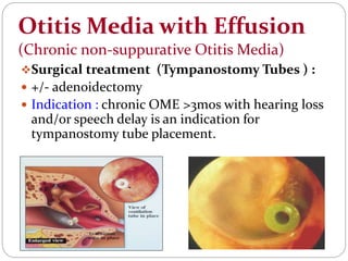 Otitis Media with Effusion
(Chronic non-suppurative Otitis Media)
Surgical treatment (Tympanostomy Tubes ) :
 +/- adenoidectomy
 Indication : chronic OME >3mos with hearing loss
and/or speech delay is an indication for
tympanostomy tube placement.
 