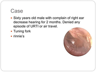 Case
 Sixty years old male with complain of right ear
decrease hearing for 2 months. Denied any
episode of URTI or air travel.
 Tuning fork
 rinnie’s
 