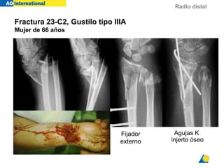 Radio distal
Fractura 23-C2, Gustilo tipo IIIA
Mujer de 66 años
Fijador
externo
Agujas K
injerto óseo
 