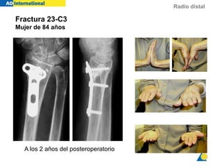Radio distal
TH 84y f
2y 1m
Fractura 23-C3
Mujer de 84 años
A los 2 años del posteroperatorio
 