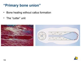 13
“Primary bone union”
• Bone healing without callus formation
• The “cutter” unit
 