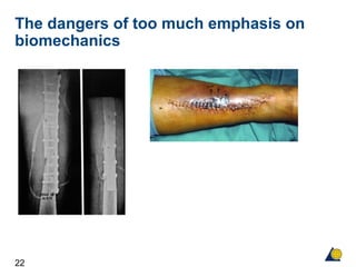 22
The dangers of too much emphasis on
biomechanics
 