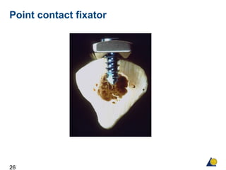 26
Point contact fixator
 