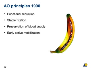 32
AO principles 1990
• Functional reduction
• Stable fixation
• Preservation of blood supply
• Early active mobilization
 