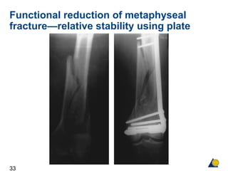 33
Functional reduction of metaphyseal
fracture—relative stability using plate
 