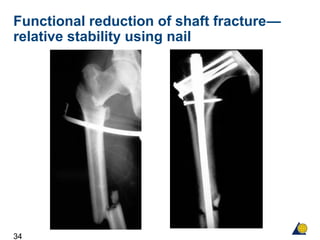 34
Functional reduction of shaft fracture—
relative stability using nail
 