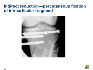 37
Indirect reduction—percutaneous fixation
of intraarticular fragment
 