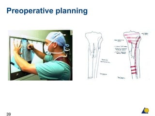39
Preoperative planning
 