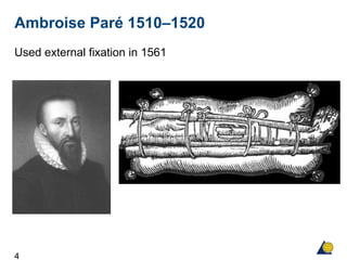 4
Ambroise Paré 1510–1520
Used external fixation in 1561
 