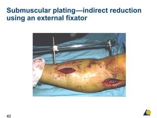 40
Submuscular plating―indirect reduction
using an external fixator
 