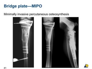 41
Bridge plate—MIPO
Minimally invasive percutaneous osteosynthesis
 