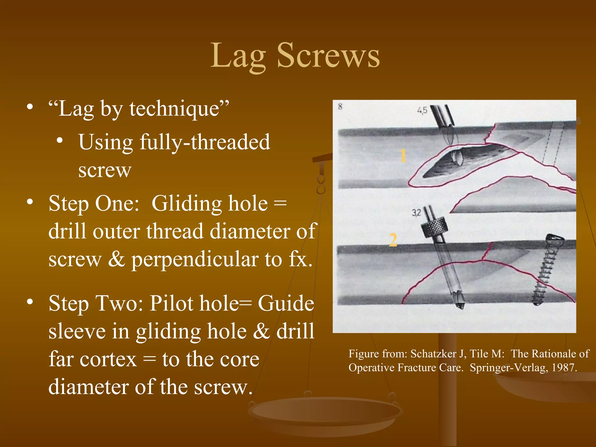1
2
Figure from: Schatzker J, Tile M: The Rationale of
Operative Fracture Care. Springer-Verlag, 1987.
Lag Screws
• “Lag by technique”
• Using fully-threaded
screw
• Step One: Gliding hole =
drill outer thread diameter of
screw & perpendicular to fx.
• Step Two: Pilot hole= Guide
sleeve in gliding hole & drill
far cortex = to the core
diameter of the screw.
 