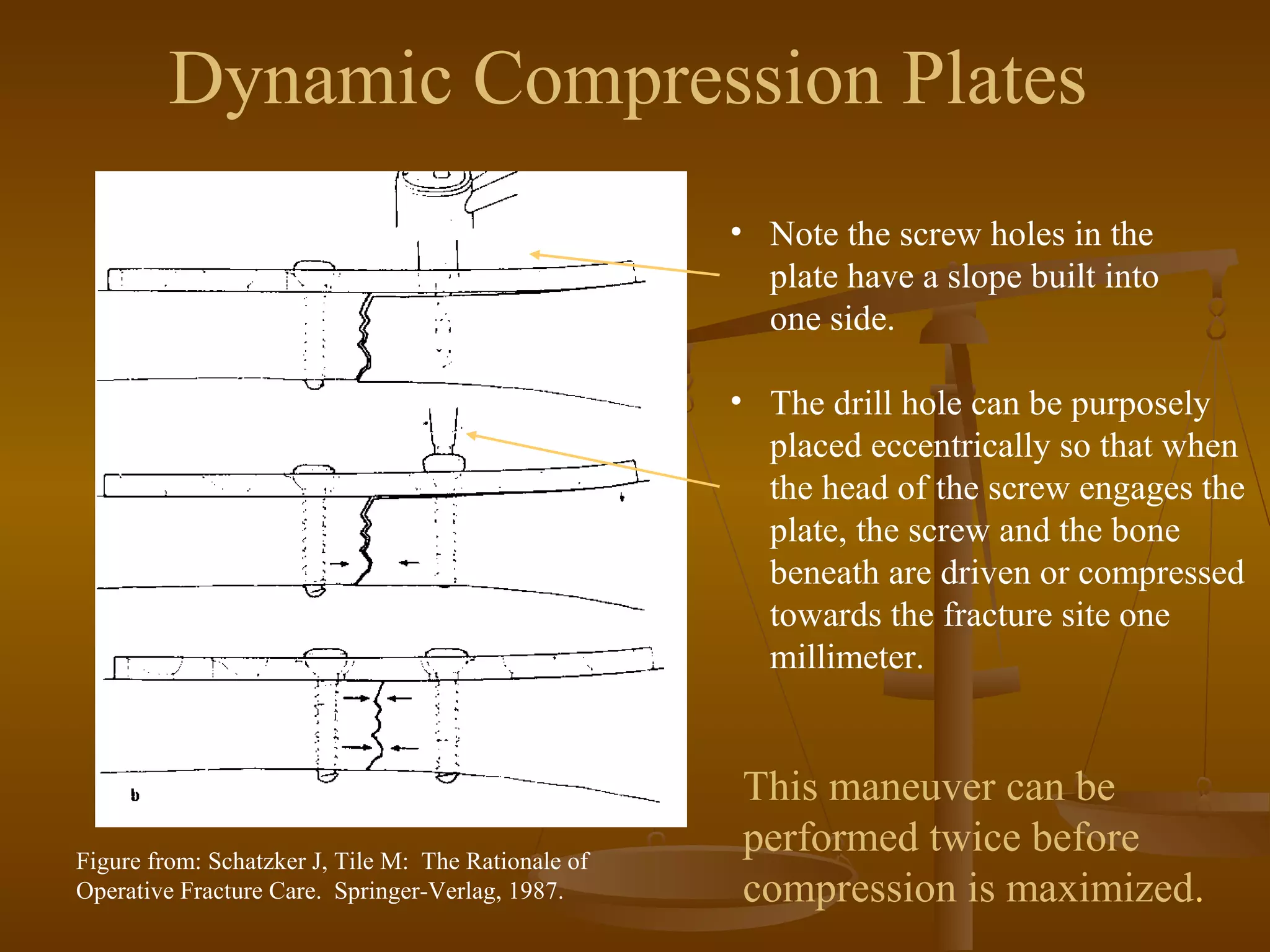 Dynamic Compression Plates
• Note the screw holes in the
plate have a slope built into
one side.
• The drill hole can be purposely
placed eccentrically so that when
the head of the screw engages the
plate, the screw and the bone
beneath are driven or compressed
towards the fracture site one
millimeter.
This maneuver can be
performed twice before
compression is maximized.
Figure from: Schatzker J, Tile M: The Rationale of
Operative Fracture Care. Springer-Verlag, 1987.
 